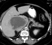 In the portal venous phase tumor becomes isodense to surrounding liver parenchyma; necrosis remains hypodense.