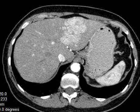 110 Hepatocellular Carcinoma Clinical Research The essential criteria of evaluation of liver hemangiomas CT images are as follows: hypodense or isodense lesion on precontrast CT images;early