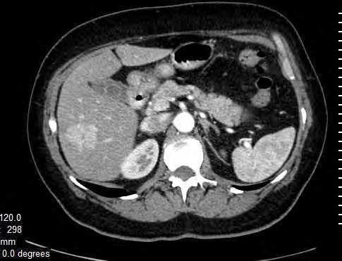 Differential Diagnosis of Hepatocellular Carcinoma on Computed Tomography 111 Etiology and pathogenesis of FNH are unclear.