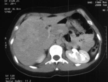 Arterial phase CT image shows lobulated enhancement with a thick irregular scar of the lesion. (b,c) In the portal venous phase, FNH is slighthy hypodense to the liver.