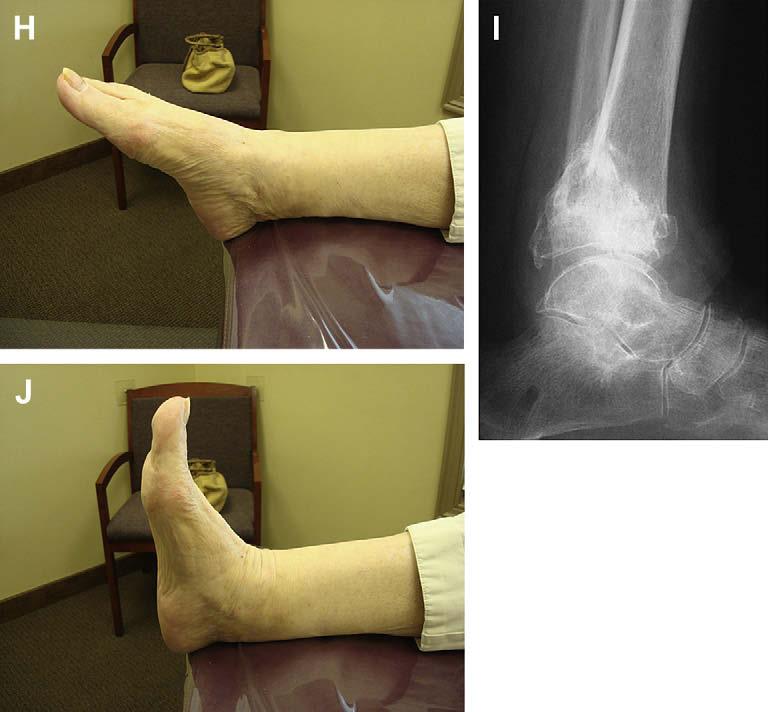 Author's personal copy The Use of Ilizarov Technique 147 Fig. 2. (continued) REFERENCES 1. Seibert FJ, Fankhauser F, Elliott B, et al. External fixation in trauma of the foot and ankle.