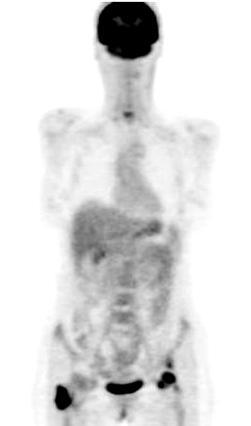EoT PET CT in lymphoma Visual assessment alone is