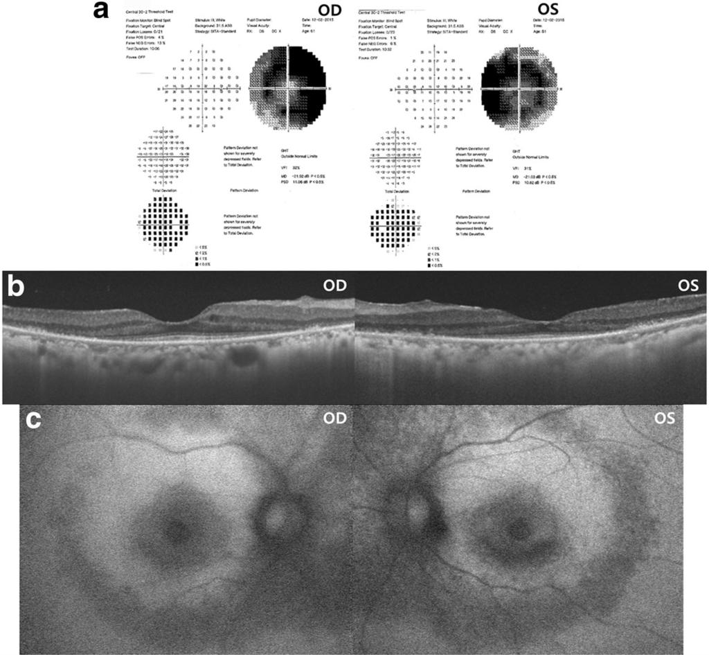 Hong et al. BMC Ophthalmology (2017) 17:124 Page 2 of 5 with decreased foveal sensitivity in both eyes (Fig. 1).