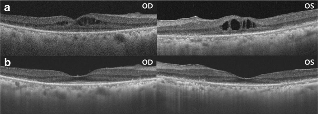 Hong et al. BMC Ophthalmology (2017) 17:124 Page 3 of 5 Fig. 2 a Cystoid macular edema (CME) shown by spectral-domain optical coherence tomography (SD-OCT).