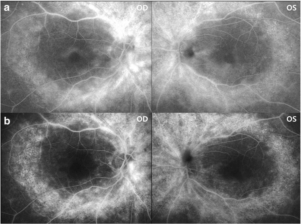 Central macular thickness (CMT) decreased from 245 to 177 μm and from 335 to 146 μm in the right and left eyes, respectively been suggested to involve breakdown of the bloodretinal barrier (BRB) as a
