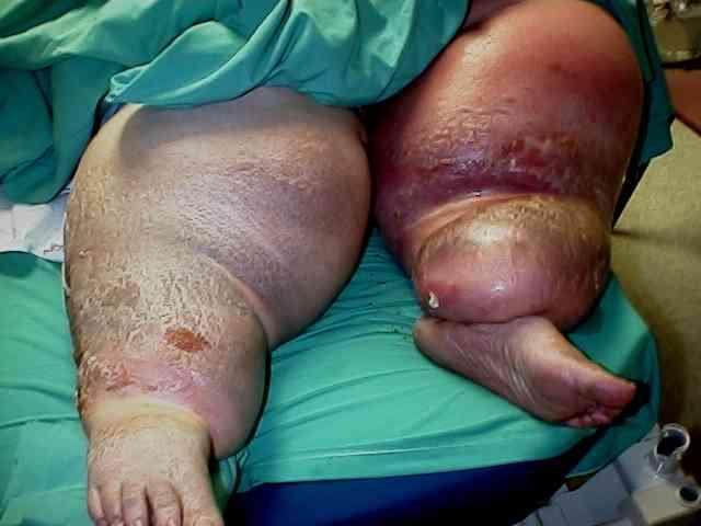 lymphedema Lymphedema is an accumulation of lymphatic fluid in the