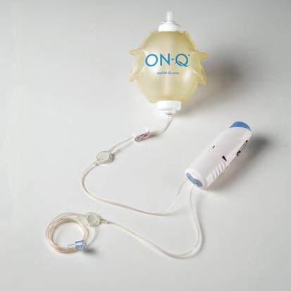 RED TAB 1 The ON-Q* pump automatically infuses the medication at a slow flow rate.