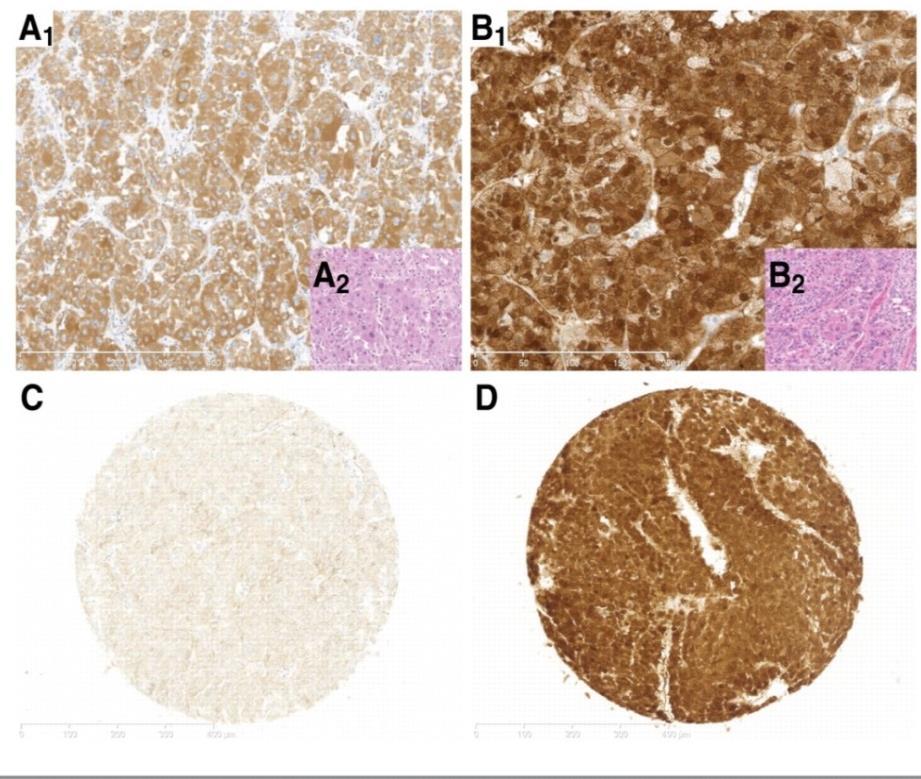 New proposal and panel of immunohistochemistry for ADRENAL CORTICAL CARCINOMAS **Diagnostic algorithm: Reticulin stain + mitosis count + necrosis + vascular invasion Criteria of malignancy