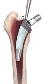 Trochanter conserving MiniHip is designed to follow the natural anatomy: there is no lateral flare and the entry point avoids the greater trochanter. 2.