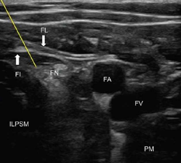 regional nerve blocks shoulder arthroplasty & arthroscopy (interscalene brachial plexus, suprascapular) total knee arthroplasty (femoral nerve) ankle replacements (popliteal) orthopaedic