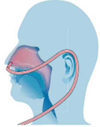 4. CO2 Ventilation Washout of nasopharyngeal dead space Improved fractions of alveolar gases with respect to carbon dioxide Low flow nasal cannula therapy is only thought