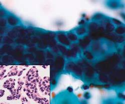 Anatomic Pathology / ORIGINAL ARTICLE A B C D Image 2 A (Case 3), This carcinosarcoma had a large serous carcinomatous component with distinctive papillary groups on the Papanicolaou smear