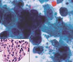 B (Case 4), Clusters of adenocarcinoma on the Papanicolaou smear were immersed in a necrotic tumor diathesis (Papanicolaou smear, 150; inset, corresponding histologic slide, H&E, 100).