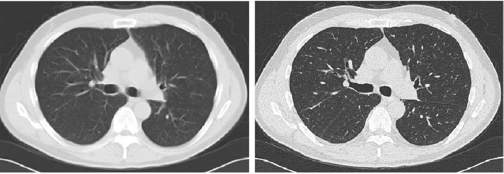 Standardized image acquisition Detection task: Detect & follow changes in nodules of 4 mm diameter Low dose Balance spatial resolution & noise Radiologist panel reviewed various images from