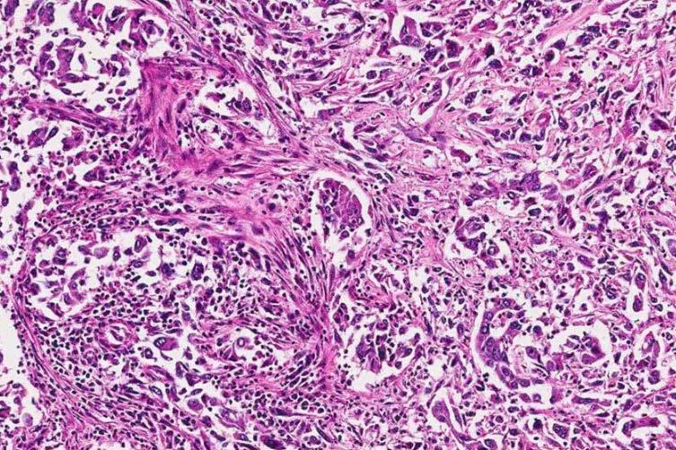 I. Epithelial tumors Pleomorphic carcinoma M/55, 50py smoker Pleomorphic carcinoma (PC) is
