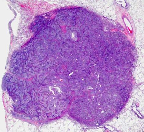 EBV in the nuclei of neoplastic cells. It is rare (0.