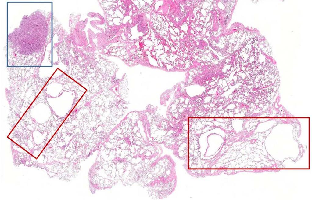 Multiple thin-walled cysts (LAM, red boxes) are