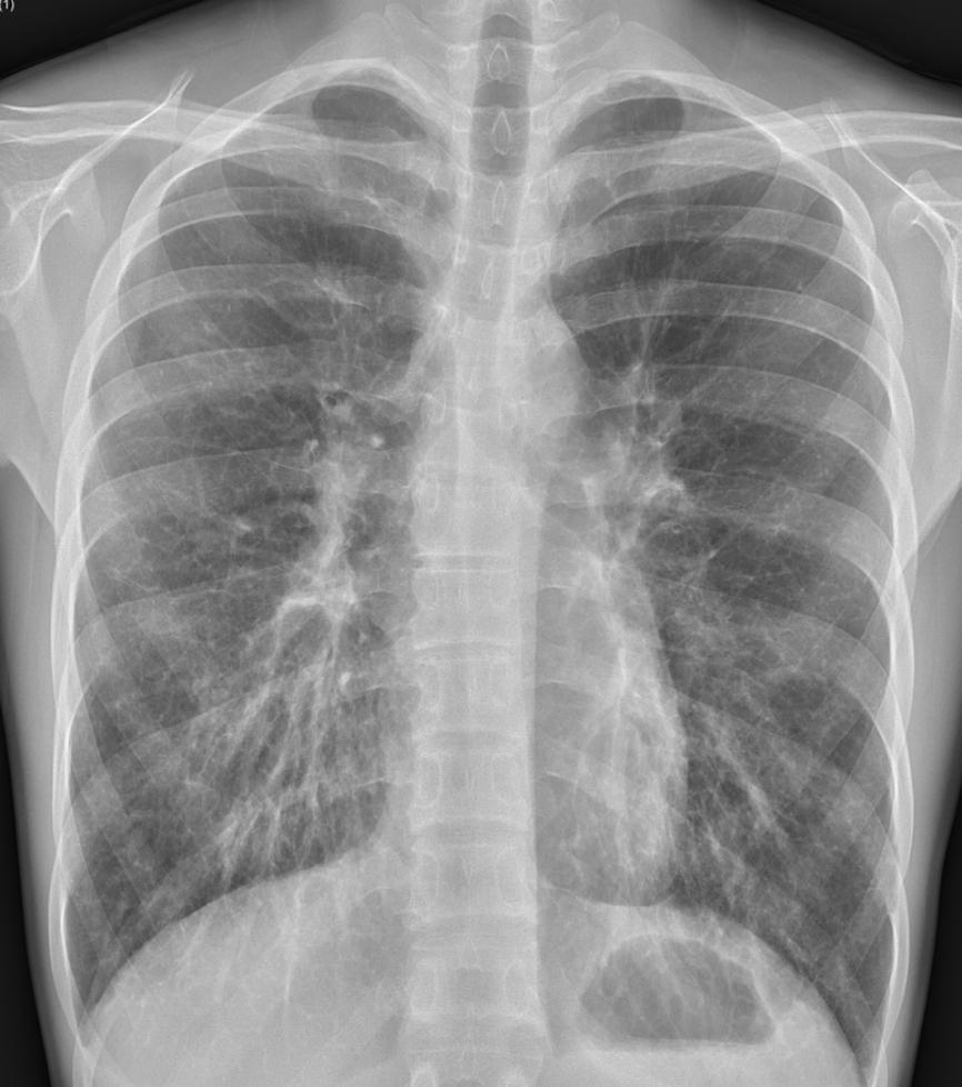 II. Mesenchymal Tumors Diffuse pulmonary lymphangiomatosis M/74 50py smoker M/19 HU: 5 Diffuse pulmonary