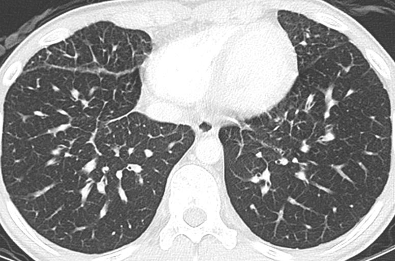 vessels of the lungs, pleura and mediastinum It is typically diagnosed shortly after birth or during childhood or young
