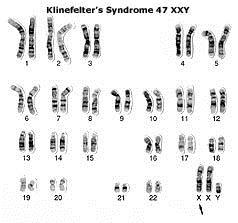 Klinefelter s syndrome