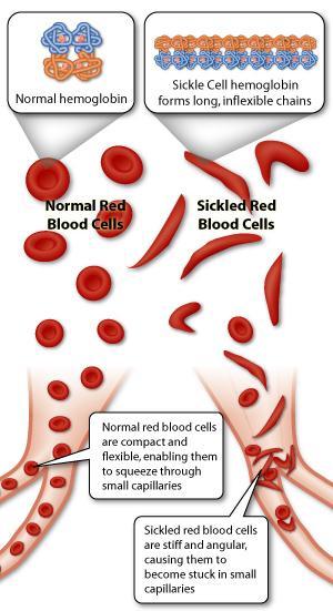 Examples: Recessive gene mutations: Sickle cell anemia red blood cells are sickle shaped instead of