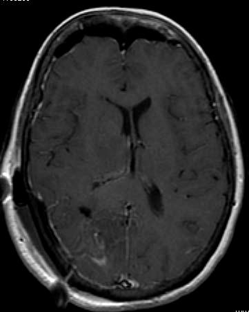 care for patients with glioblastoma, there has been an