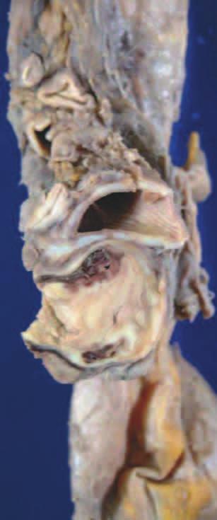 Multiple cystic lesions and fibrous changes were observed in the bilateral lung fields. Honey-comb like appearances were found dominantly in the left and back side.