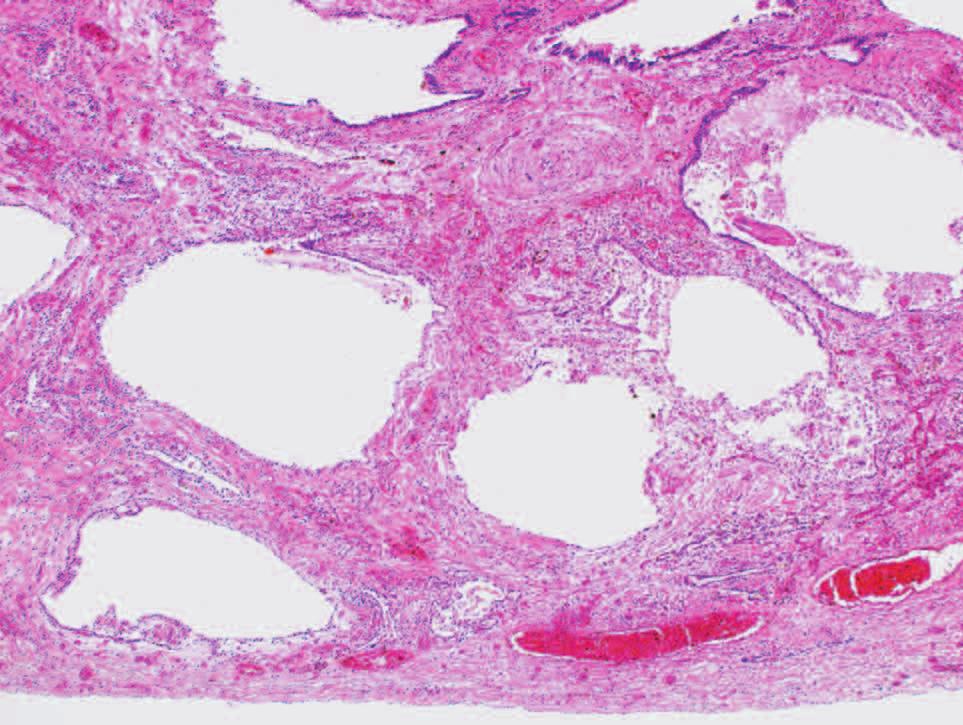 Samples from the left lower lobe showed the pleural thickness and honeycomb-like appearance with dense fibrosis histologically (Figure 5). This 3A 3B Figure 3A.