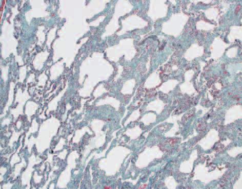 fibrosis was temporally homogeneous and lacked fibroblastic foci.
