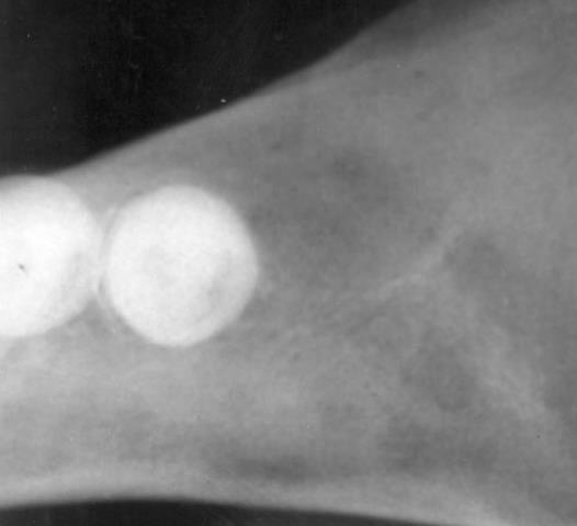 permanent teeth -Not often swelling - Bag of teeth on radiograph -Frequently maxillary anterior sextant -Radiopacities in the bone represents thickening of the trabeculae -No radiolucent margins