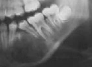 teeth -RO on mesial root of 46 -RL line