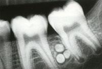 outline -Fused to tooth root, obscuring PDL -RR