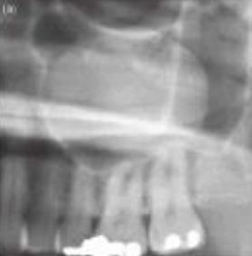 wall above the inferior turbinate. It communicates with the nasal cavity, allowing drainage of sinus fluids How does the maxillary antrum present on a panoramic radiograph?