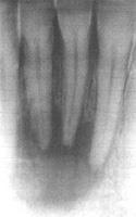 unerupted tooth -No RR -Attached to or just below