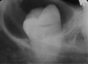 honey comb appearance -Root resorption -Well