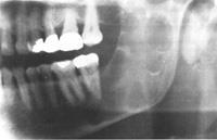 displacement of teeth -Appears to originate between