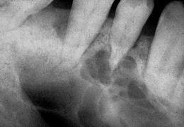 keratocyst (if other teeth were non vital, could be