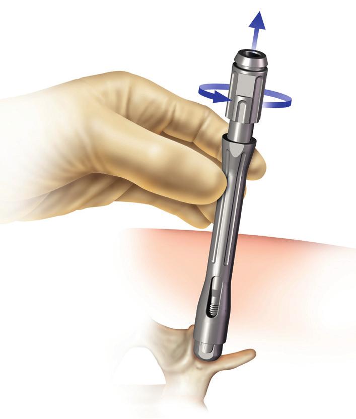 If additional cement is needed beyond its working time, dispose of the cement and cannula. Use a new cannula and mix a new dose of cement for the remaining screws.