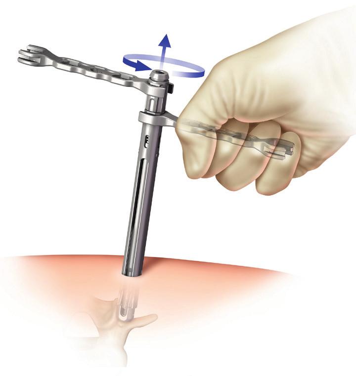 Subsequent Level Augmentation Step 9 Subsequent level augmentation Place the existing cannula and cement reservoir into the next alignment guide and repeat the procedure as described in steps 6 and 7.