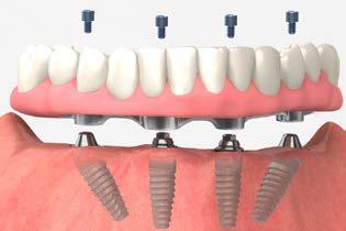overdenture: chairside pick-up using existing denture ball abutment