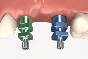 cement-retained restorations cement-retained bridge using cementable abutments Cement-retained implant restorations are similar to conventional crown and bridge restorations.
