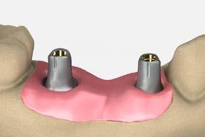 Evaluate interocclusal dimensions, angulations, and tissue contour. Mark the abutments for the necessary vertical reduction and gingival contour. Note: A minimum of 1.5-2.