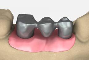cement-retained restorations cement-retained bridge using cementable abutments 6 Lab step - Wax the framework, sprue, invest and cast In preparation to wax and cast the coping, block out the