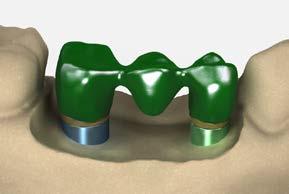 Confirm the framework fits passively on the modified abutments. Send to the clinician for framework try-in.