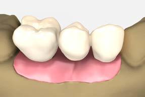 cement-retained restorations cement-retained bridge using cementable abutments 9 Try in the bridge framework Try in the bridge framework.