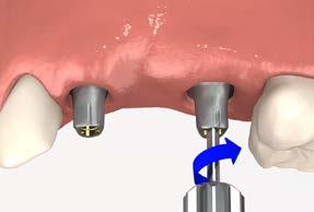 Remove the modified abutments, one at a time, replacing them with the healing abutments or temporary prosthesis.