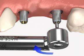 cement-retained restorations cement-retained bridge using cementable abutments 12 Tighten the abutment screws Tighten the abutment screws to 30 Ncm using a calibrated torque wrench and an.050 (1.