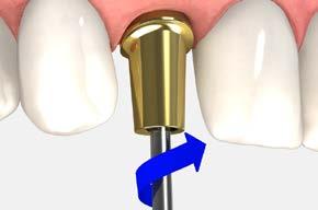 implant with an.050 (1.25mm) hex driver. Make sure the implant prosthetic platform is free of bone and soft tissue.