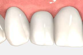 cement-retained restorations chairside modification of cement-retained abutments 9 Remove the temporary Sanitize the final prosthesis following a standard clinical protocol.