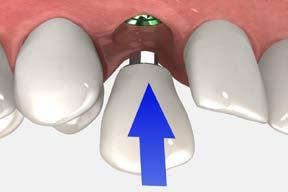 screw-retained restorations screw-retained single crowns using custom-cast abutments 7 Lab step - Apply the porcelain Prepare the cast abutment to receive the opaque layer according to routine